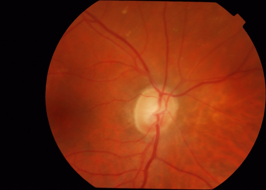 Optic disc segmentation in Drishti-GS dataset